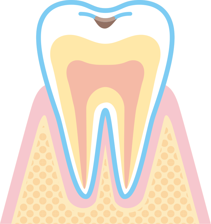 C1：エナメル質に達した虫歯