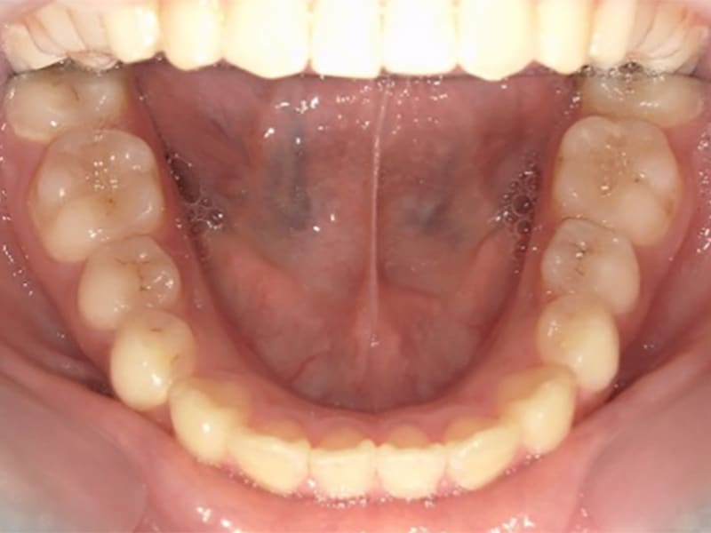 上顎前突・開咬の症例