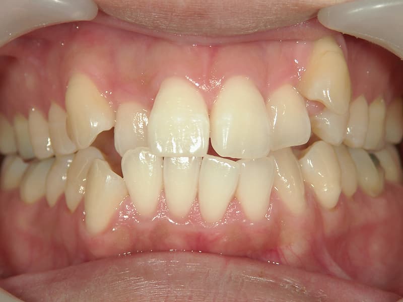 [歯列矯正症例 No.001] 叢生（乱ぐい歯・八重歯）の症例 | 河原町歯科・矯正歯科クリニック