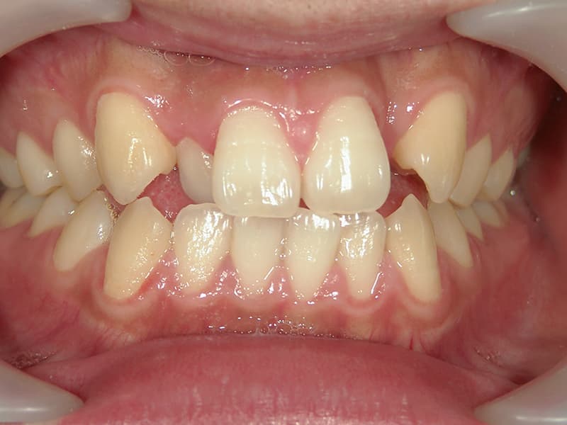 [歯列矯正症例 No.003] 叢生（乱ぐい歯・八重歯）の症例 | 河原町歯科・矯正歯科クリニック
