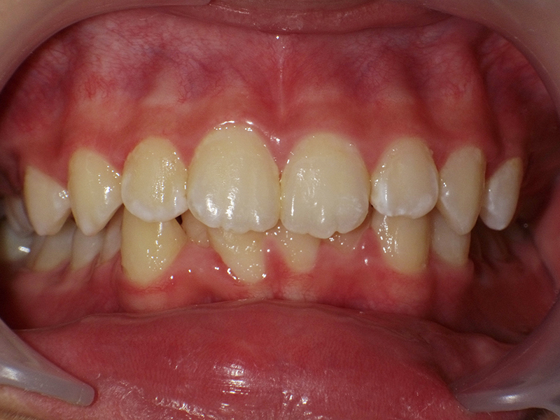 [歯列矯正症例 No.004] 叢生（乱ぐい歯・八重歯）・過蓋咬合の症例 | 河原町歯科・矯正歯科クリニック