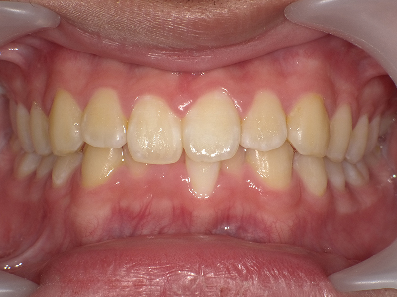 [歯列矯正症例 No.006] 叢生（乱ぐい歯・八重歯）の症例 | 河原町歯科・矯正歯科クリニック