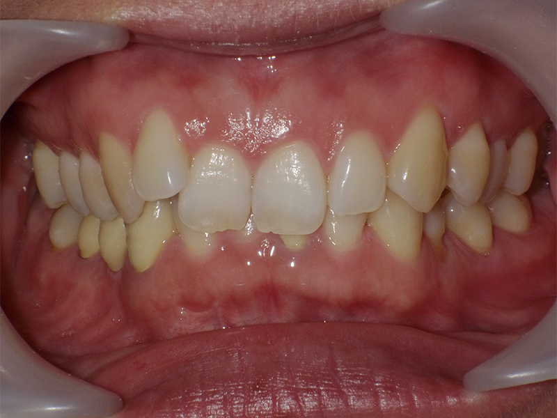 [歯列矯正症例 No.007] 叢生（乱ぐい歯・八重歯）の症例 | 河原町歯科・矯正歯科クリニック