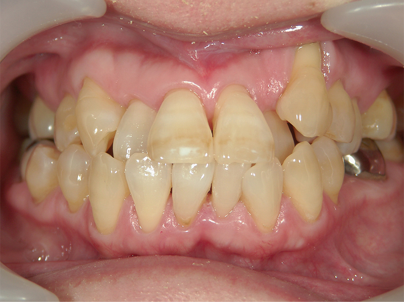 [歯列矯正症例 No.008] 叢生（乱ぐい歯・八重歯）の症例 | 河原町歯科・矯正歯科クリニック