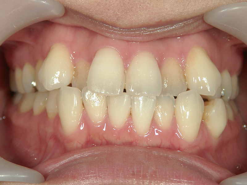 [歯列矯正症例 No.009] 叢生（乱ぐい歯・八重歯）の症例 | 河原町歯科・矯正歯科クリニック