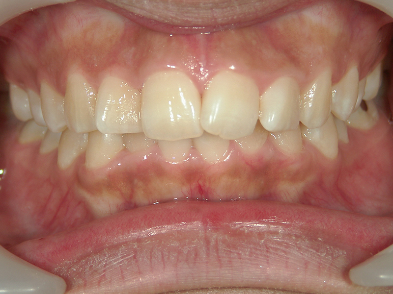 [歯列矯正症例 No.010] 叢生（乱ぐい歯・八重歯）の症例 | 河原町歯科・矯正歯科クリニック