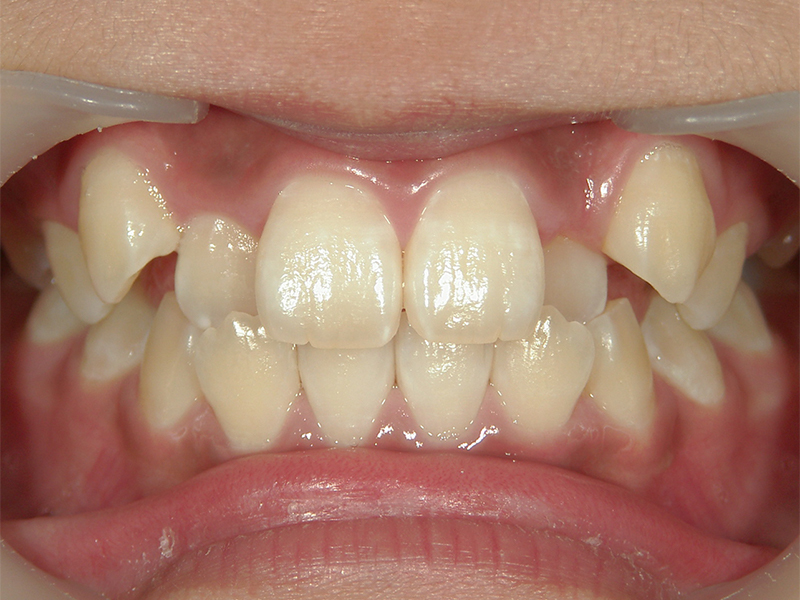 [歯列矯正症例 No.011] 叢生（乱ぐい歯・八重歯）の症例 | 河原町歯科・矯正歯科クリニック