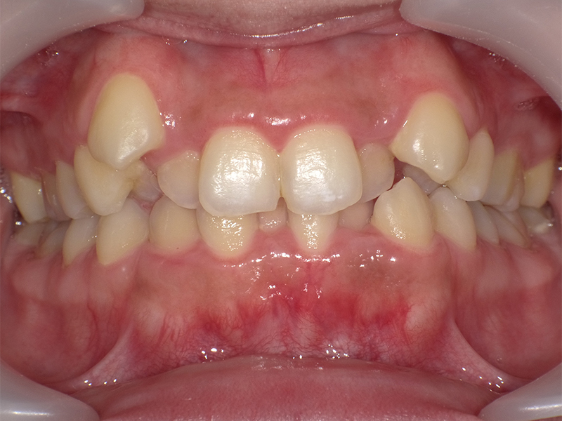 [歯列矯正症例 No.012] 叢生（乱ぐい歯・八重歯）の症例 | 河原町歯科・矯正歯科クリニック