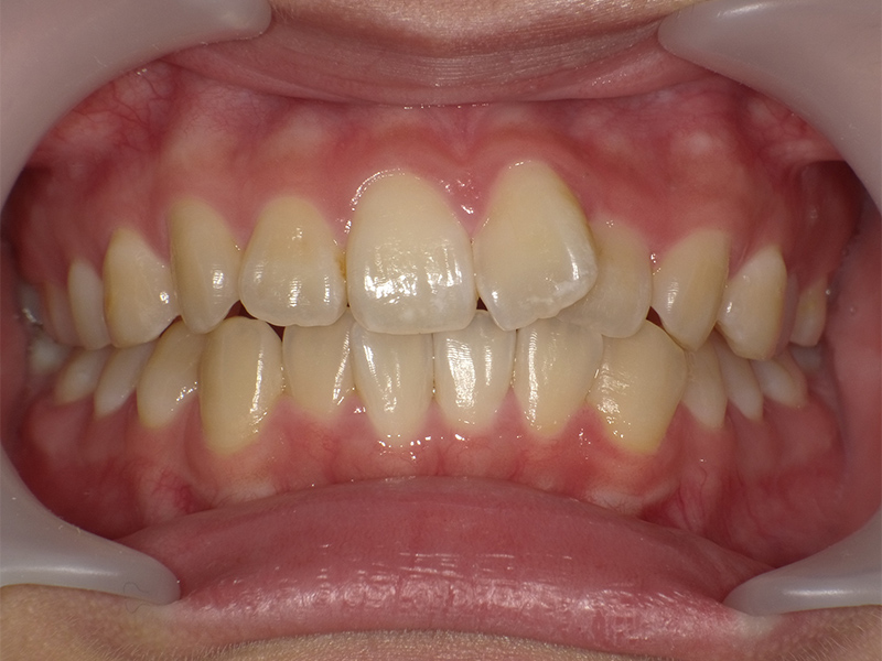 [歯列矯正症例 No.013] 叢生（乱ぐい歯・八重歯）の症例 | 河原町歯科・矯正歯科クリニック