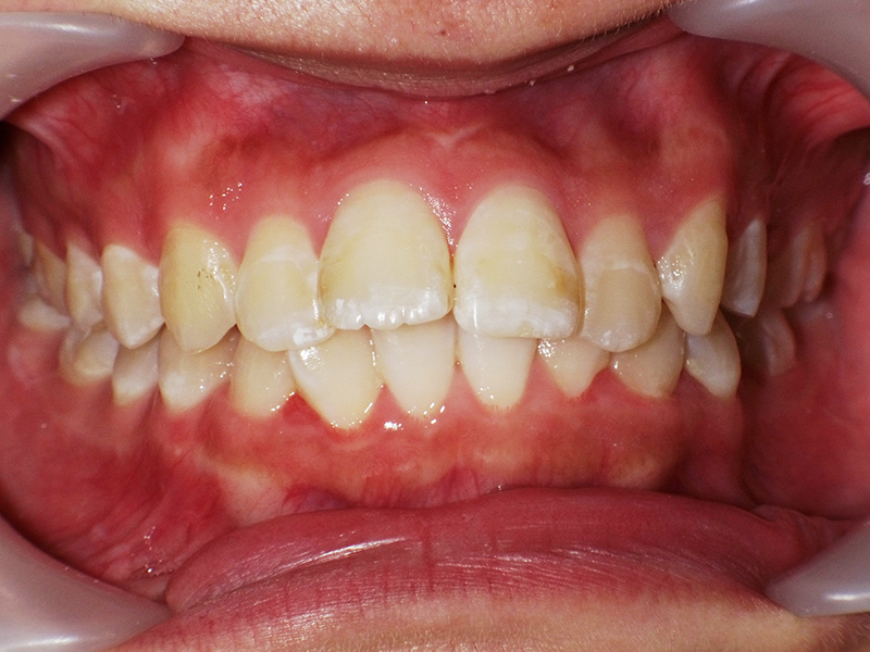 [歯列矯正症例 No.015] 上顎前突（出っ歯）の症例 | 河原町歯科・矯正歯科クリニック