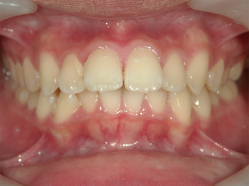 [歯列矯正症例 No.017] 上顎前突（出っ歯）の症例 | 河原町歯科・矯正歯科クリニック