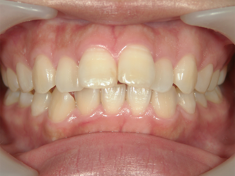[歯列矯正症例 No.018] 上顎前突（出っ歯）の症例 | 河原町歯科・矯正歯科クリニック