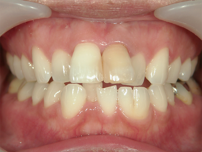 [歯列矯正症例 No.020] 上顎前突（出っ歯）の症例 | 河原町歯科・矯正歯科クリニック