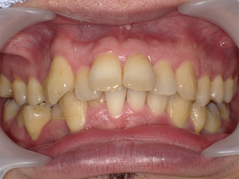 [歯列矯正症例 No.021] 上顎前突（出っ歯）の症例 | 河原町歯科・矯正歯科クリニック