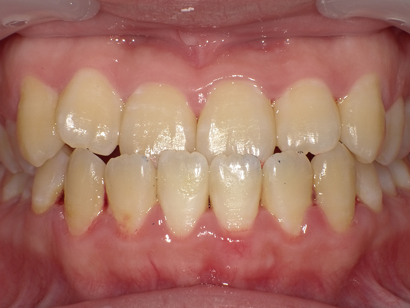 [歯列矯正症例 No.022] 下顎前突（受け口）の症例 | 河原町歯科・矯正歯科クリニック