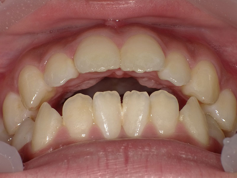 [歯列矯正症例 No.026] 開咬（オープンバイト）の症例 | 河原町歯科・矯正歯科クリニック