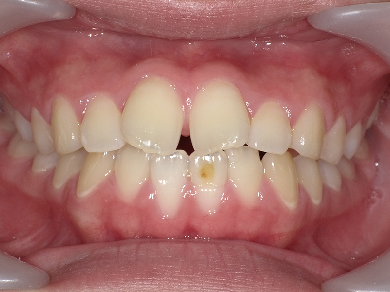 [歯列矯正症例 No.027] 空隙歯列（すきっ歯）の症例 | 河原町歯科・矯正歯科クリニック