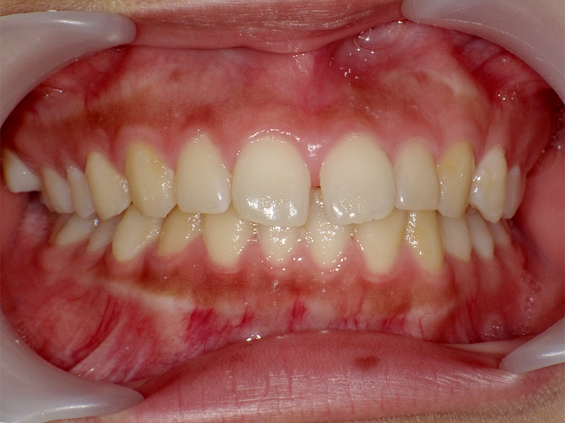 [歯列矯正症例 No.028] 空隙歯列（すきっ歯）の症例 | 河原町歯科・矯正歯科クリニック