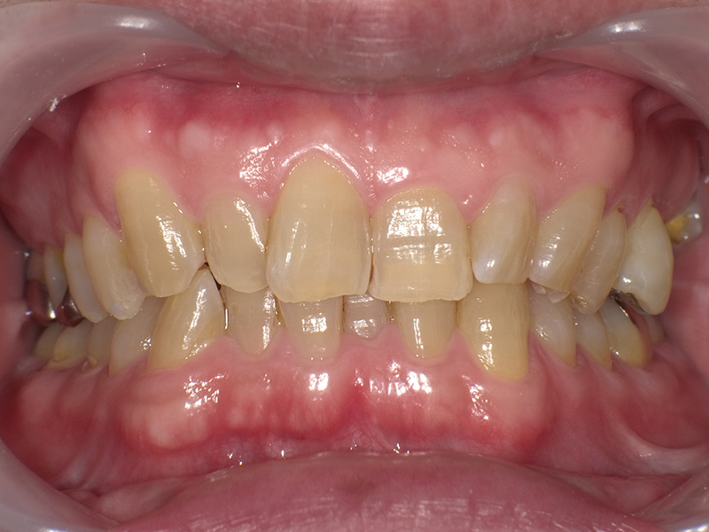 [歯列矯正症例 No.029] 過蓋咬合の症例 | 河原町歯科・矯正歯科クリニック